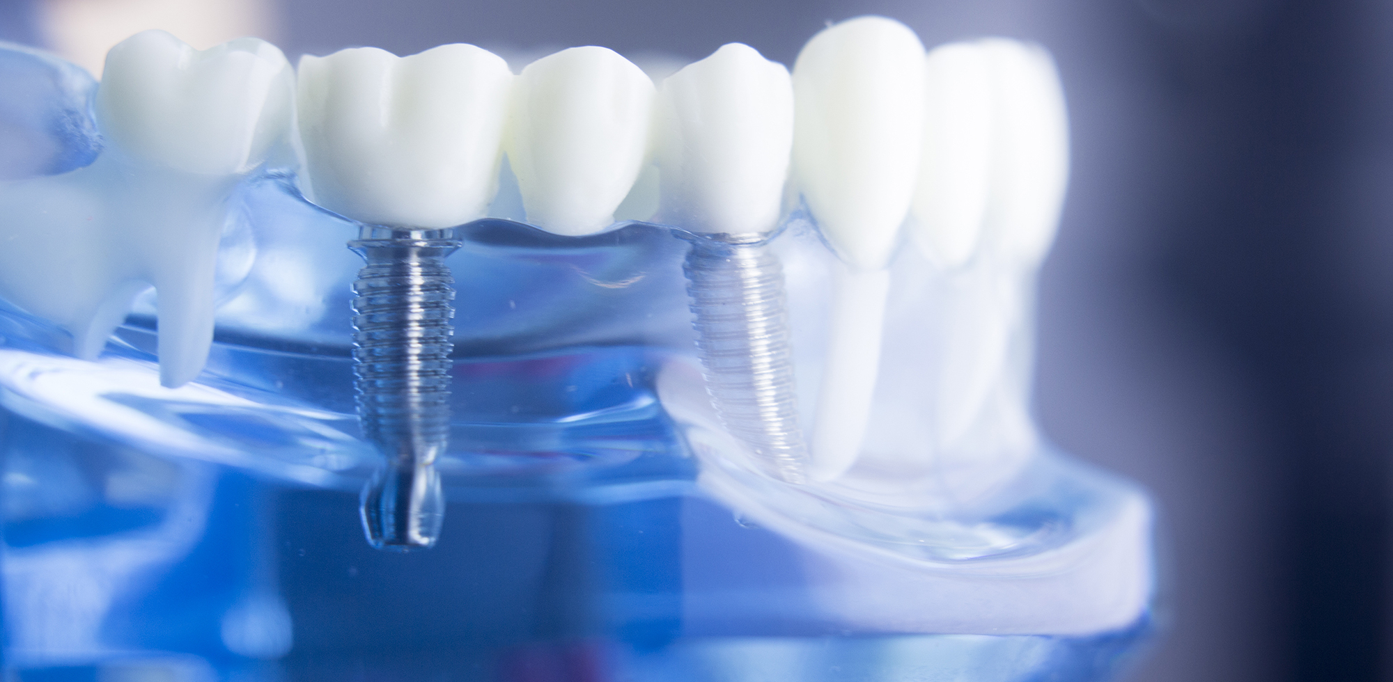 Implant Center