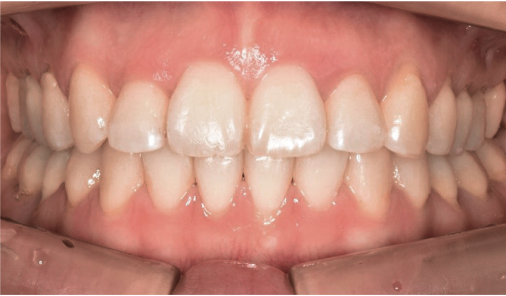 Frontal intraoral photo after adult orthodontic treatment at Today Dental Bucheon clinic