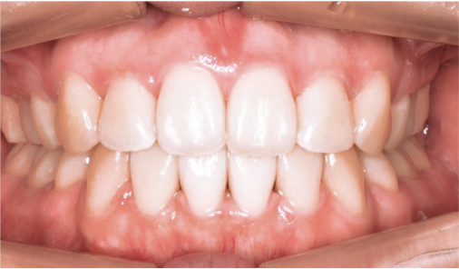 Aligned front teeth after orthodontic treatment, adult patient at Today Dental Bucheon clinic
