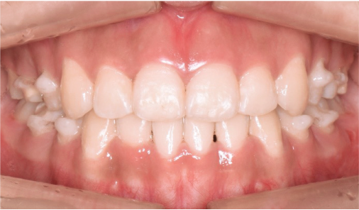 Intraoral view of corrected tooth alignment after adult orthodontics at Today Dental Bucheon clinic