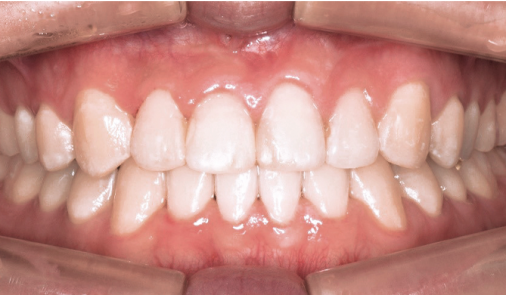 Post-treatment intraoral photo of an adult orthodontic patient at Today Dental Bucheon clinic