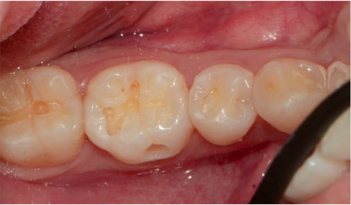 Intraoral view of molars with stained grooves examined before cavity treatment, Bucheon clinic