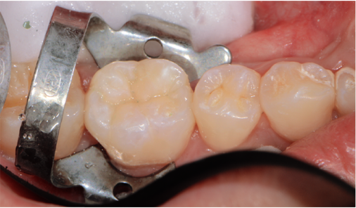Molar restored with a tooth-colored filling, shown with dental isolation in place, Bucheon clinic