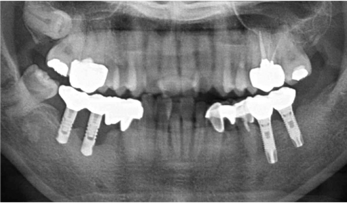 Panoramic X-ray after full-mouth implant treatment at Today Dental Bucheon clinic