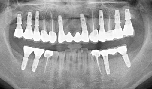 Panoramic X-ray showing completed full-mouth implant treatment at Today Dental Bucheon clinic