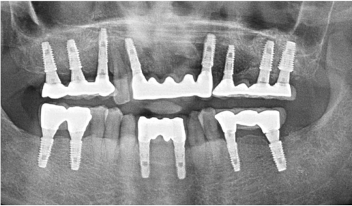 Panoramic X-ray of upper and lower implant restorations after full-mouth treatment at Today Dental Bucheon clinic