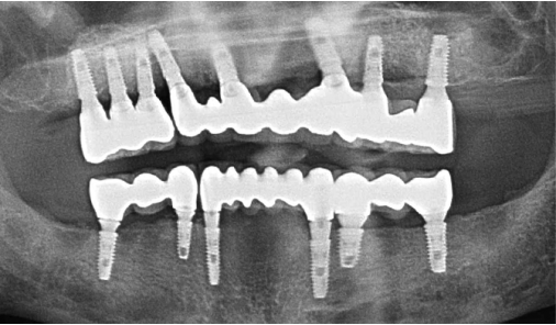 Panoramic X-ray after full-arch implant prostheses were completed at Today Dental Bucheon clinic