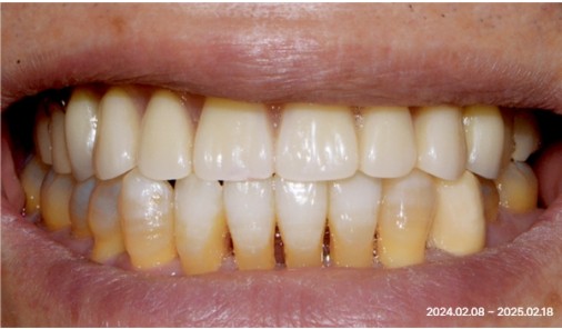 Frontal photo of restored teeth after implant denture treatment at Today Dental Bucheon clinic