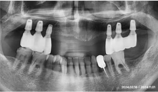Panoramic X-ray after implant denture treatment at Today Dental Bucheon clinic
