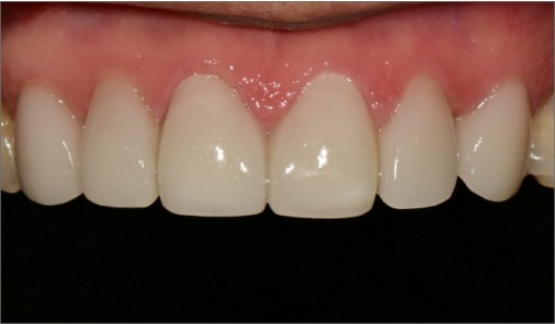 Upper front teeth after minimal-prep veneers, with the gap between the central incisors closed and an even tooth shade