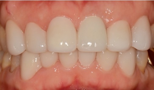 Front teeth after veneer treatment correcting a chipped central incisor and mismatched tooth colour