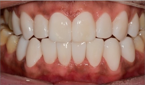 Full smile after veneer treatment with a brighter, harmonised upper and lower smile line
