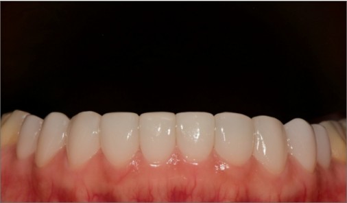 Lower front teeth with even, natural-looking edges after veneer treatment