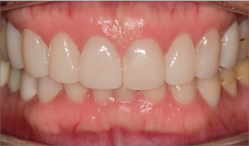 Front teeth with minor chips and uneven incisal edges refined with veneers within one week