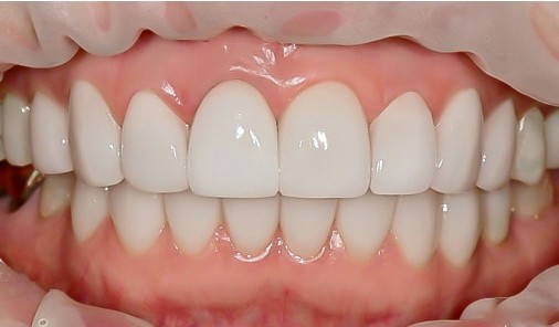 Bright, harmonised smile after veneer treatment correcting a discoloured front tooth at the Bucheon clinic