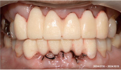 Frontal intraoral photo after one-day implant treatment at Today Dental Bucheon clinic