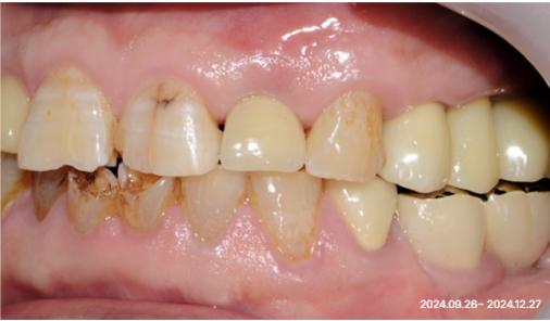 Lateral intraoral photo of implant crowns after one-day implant treatment at Today Dental Bucheon clinic