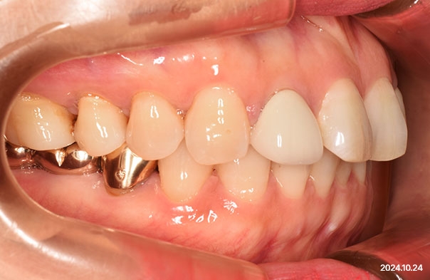 Lateral intraoral photo after molar intrusion orthodontics performed before prosthetic treatment