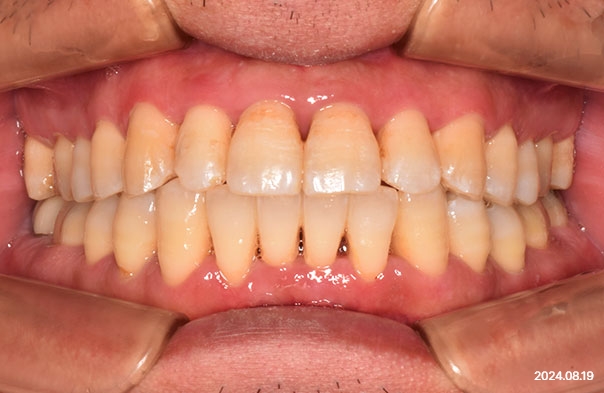 Frontal intraoral photo after partial orthodontic treatment of front teeth in a patient with periodontitis