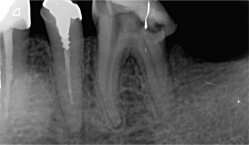Periapical X-ray of a lower molar before root canal retreatment, Bucheon clinic