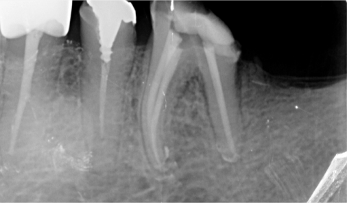 Periapical X-ray after root canal retreatment showing canals filled along their full length, Bucheon clinic