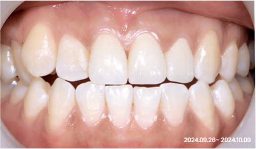 After smile shaping case 01