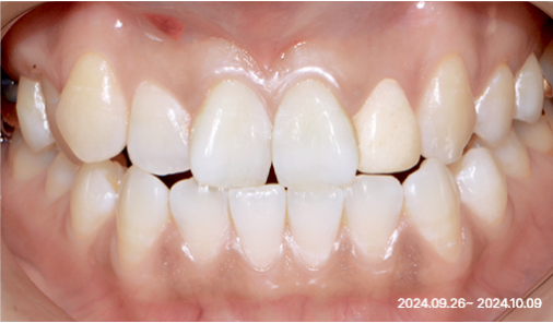 Before smile shaping case 01