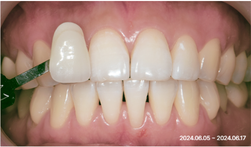 After smile shaping case 02