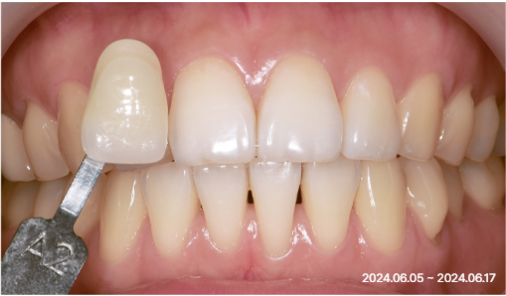 Before smile shaping case 02