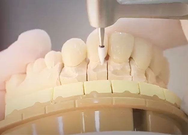 Dental lab shade matching illustration